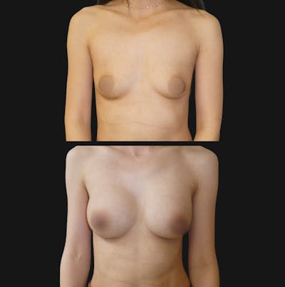 Breast Augmentation Before & After Gallery - Patient 791450 - Image 1