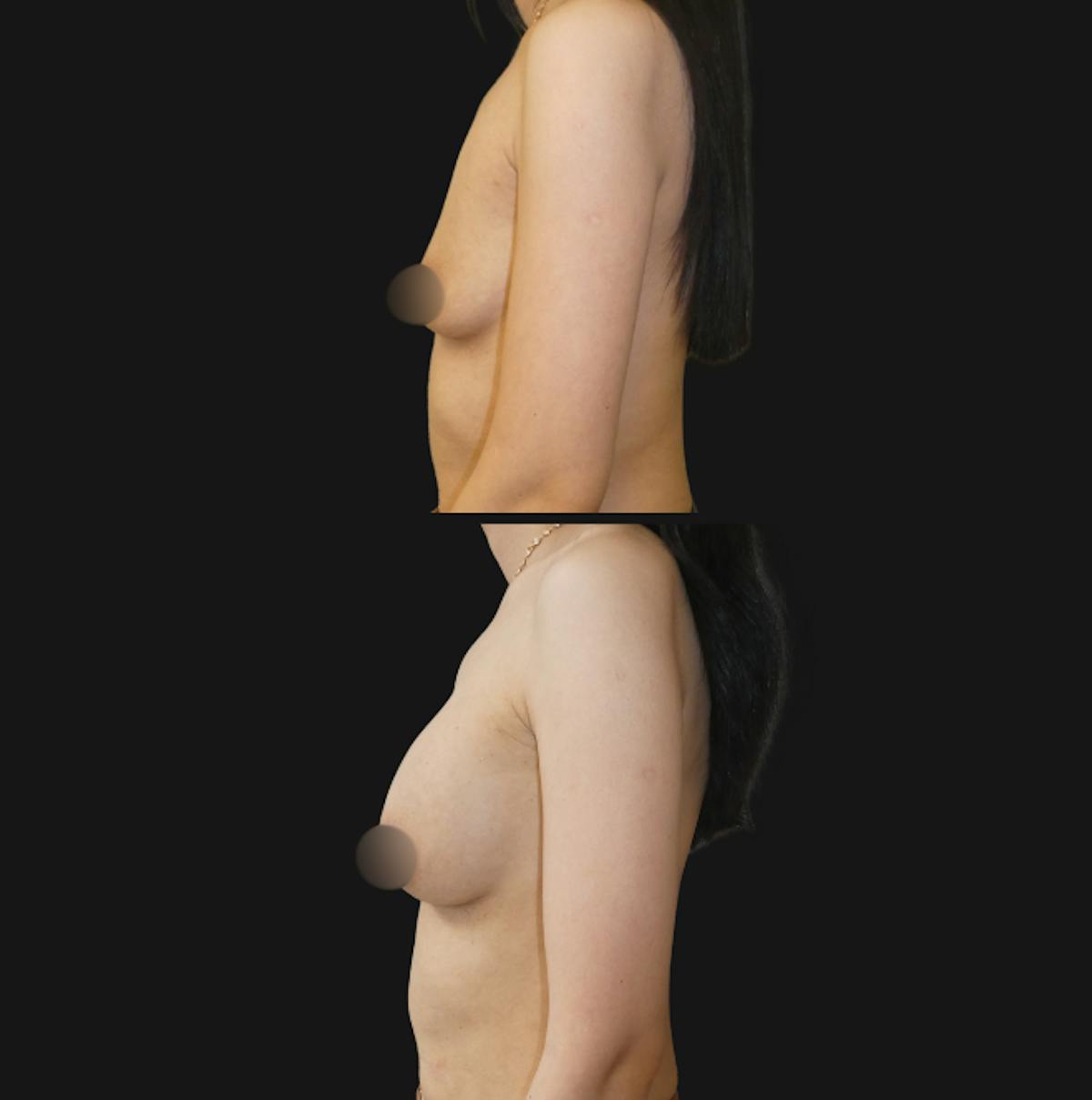 Breast Augmentation Before & After Gallery - Patient 791450 - Image 2
