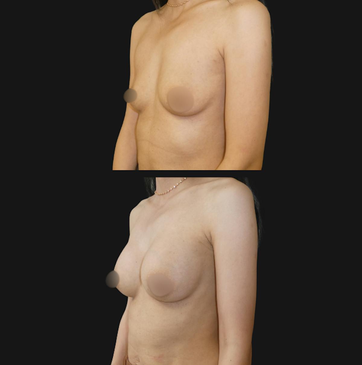 Breast Augmentation Before & After Gallery - Patient 791450 - Image 4