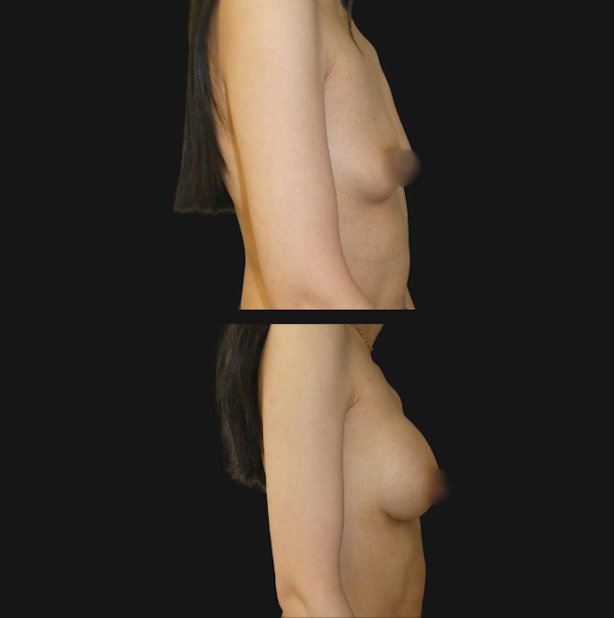Breast Augmentation Before & After Gallery - Patient 791450 - Image 3