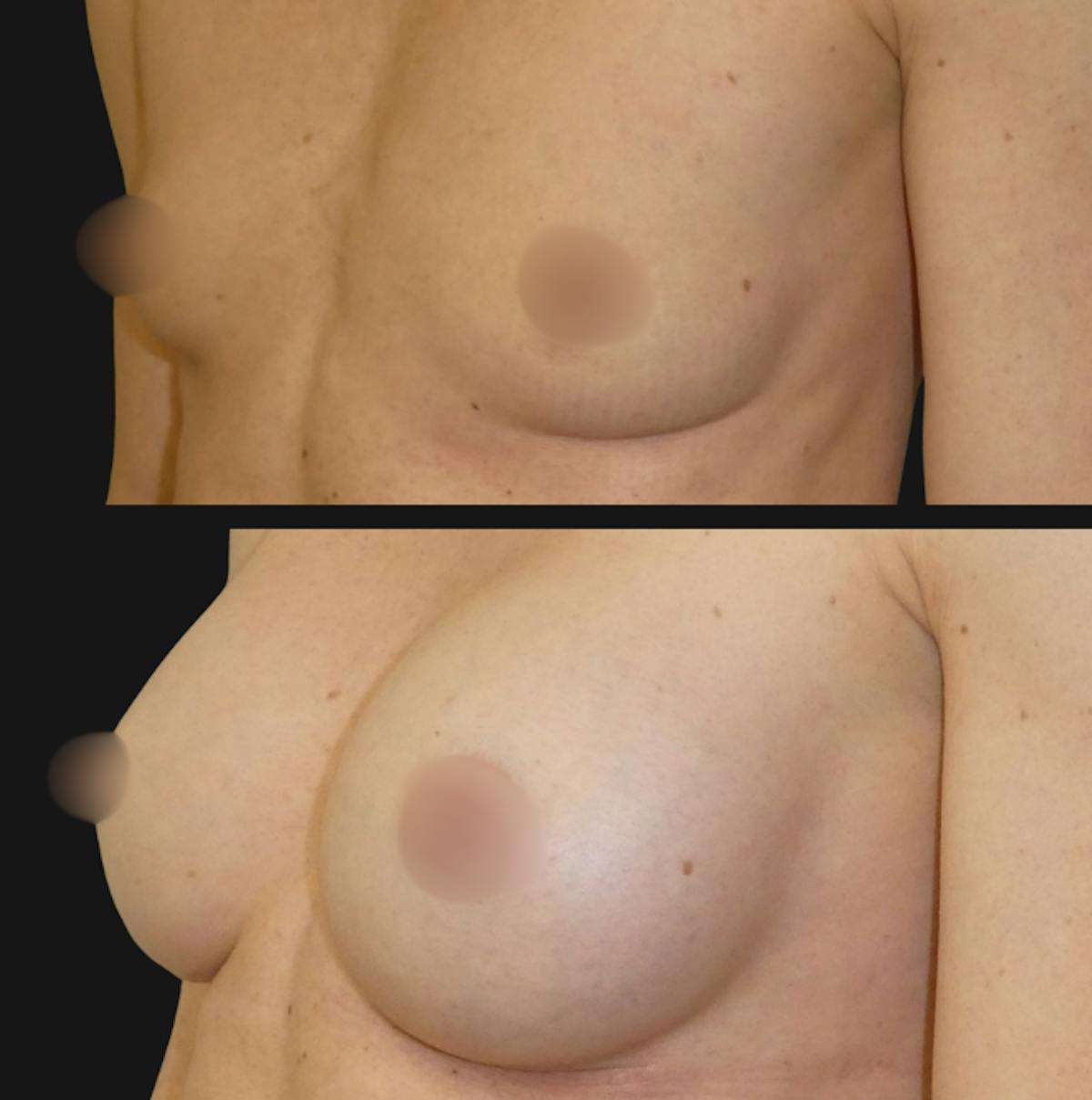 Breast Augmentation Before & After Gallery - Patient 309474 - Image 2