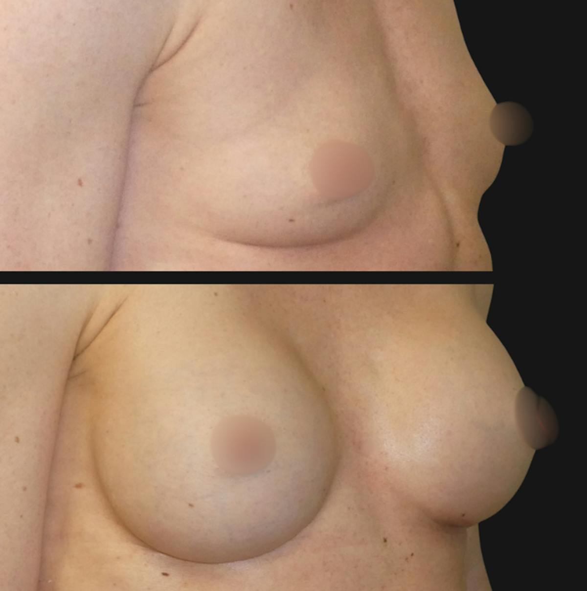 Breast Augmentation Before & After Gallery - Patient 309474 - Image 3