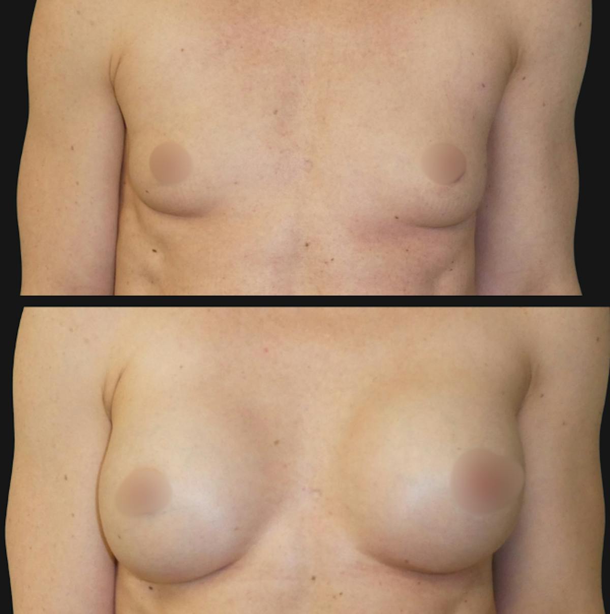Breast Augmentation Before & After Gallery - Patient 309474 - Image 1