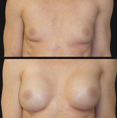Breast Augmentation Before & After Gallery - Patient 309474 - Image 1