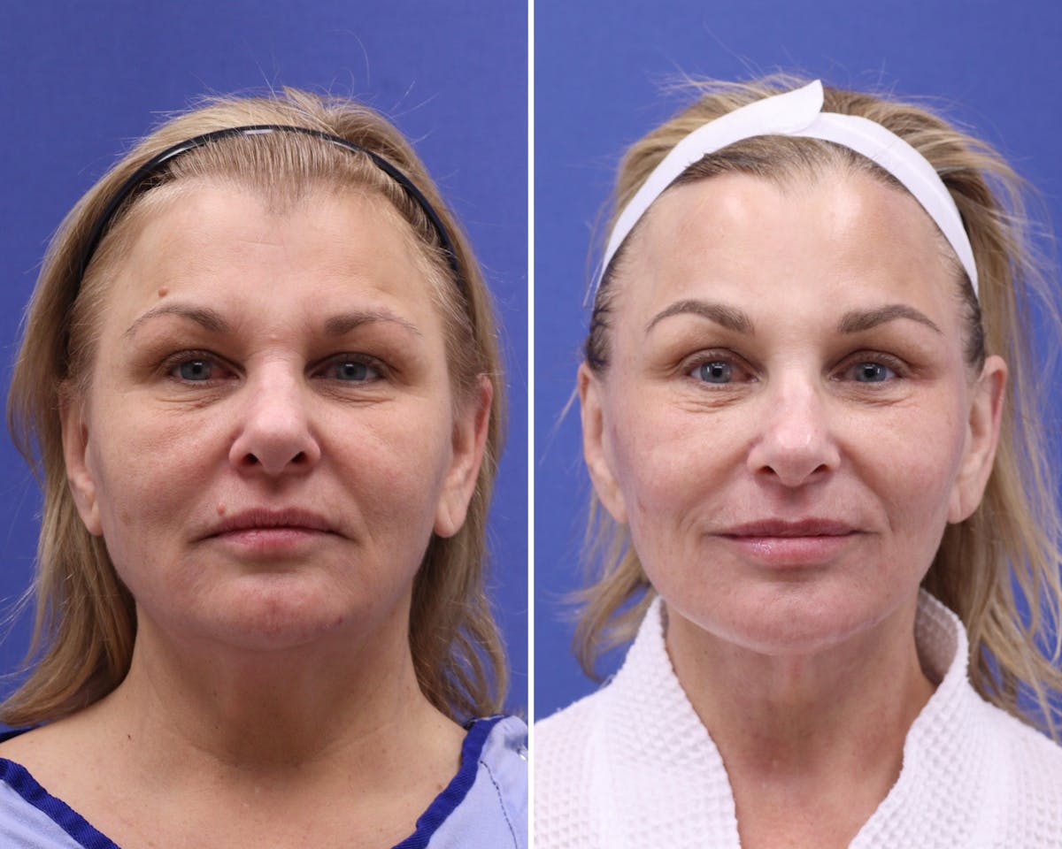 Facelift Before & After Gallery - Patient 287217 - Image 1