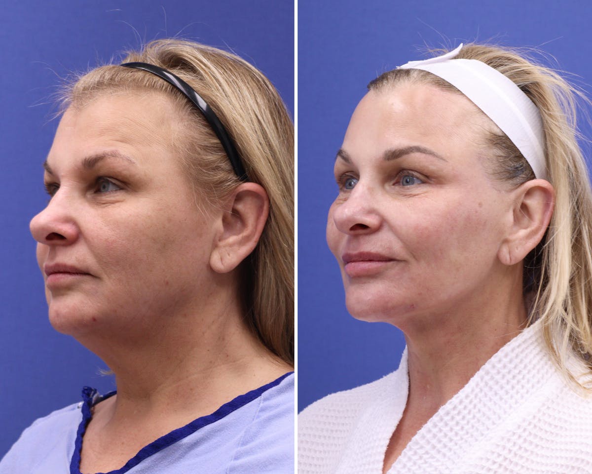 Facelift Before & After Gallery - Patient 287217 - Image 2