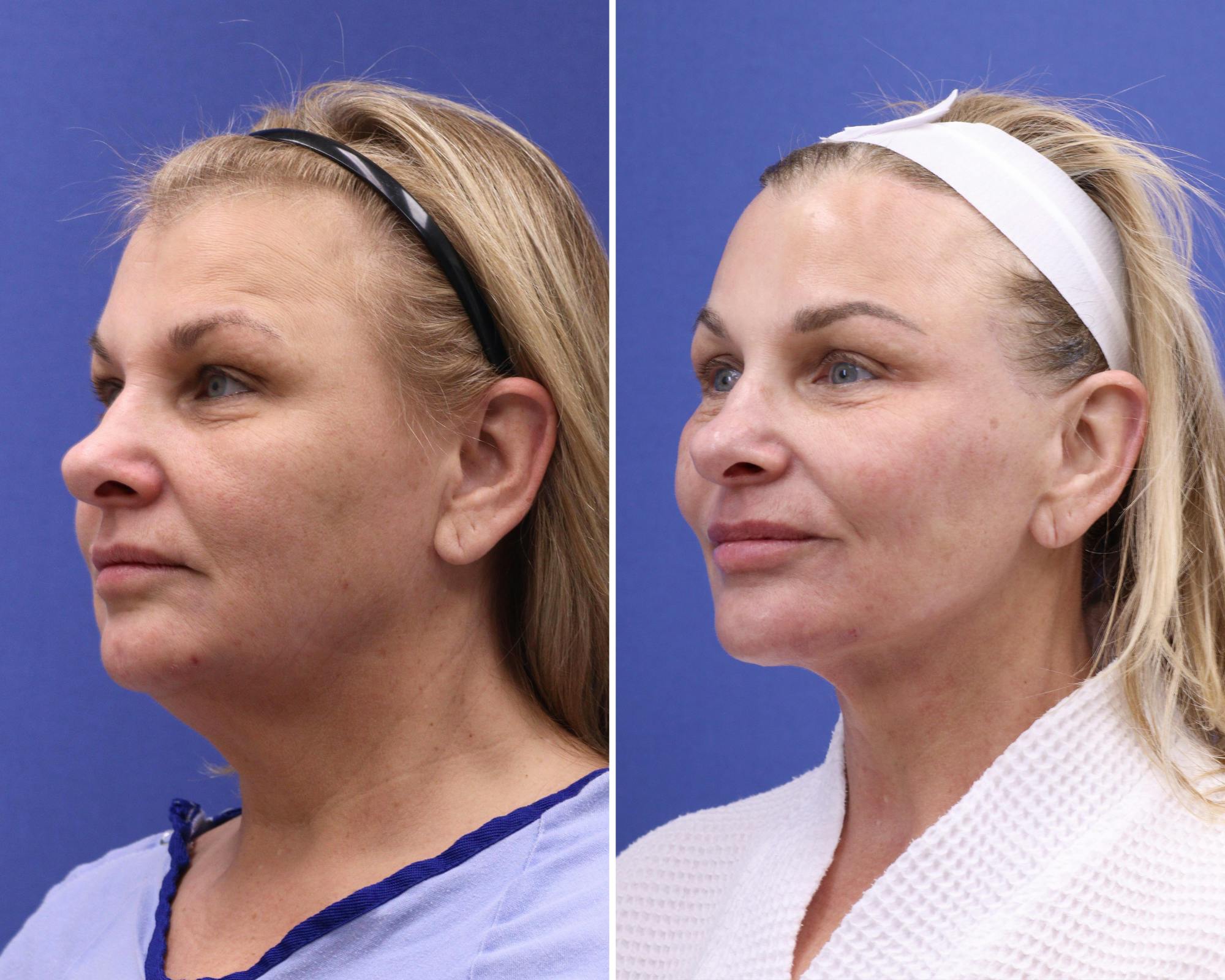 Blepharoplasty Before & After Gallery - Patient 135442 - Image 2