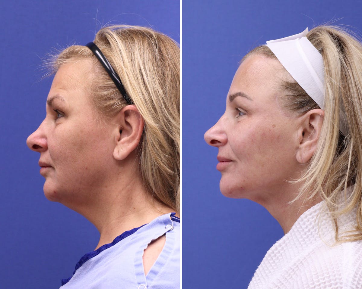 Facelift Before & After Gallery - Patient 287217 - Image 3