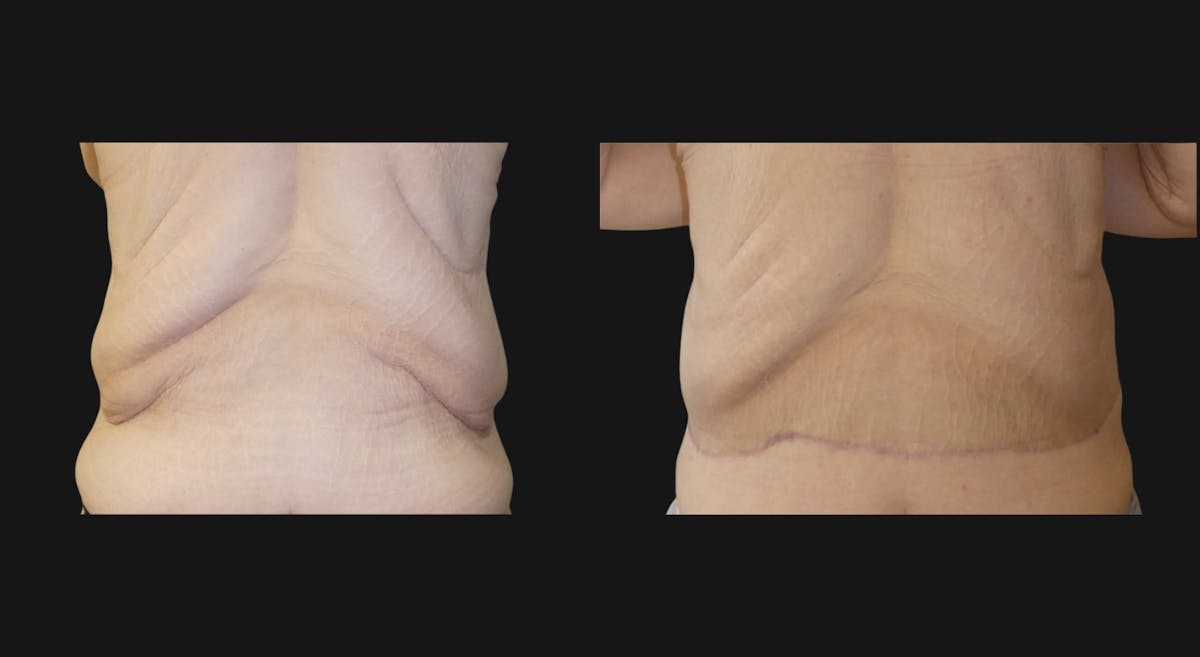 Body Lift Before & After Gallery - Patient 141778 - Image 1