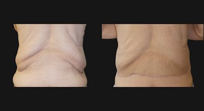 Body Lift Before & After Gallery - Patient 141778 - Image 1