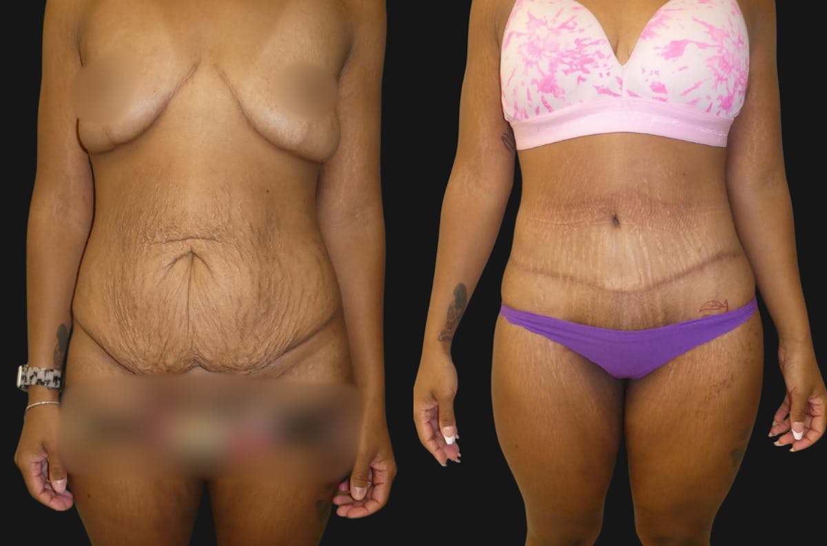 Tummy Tuck / Abdominoplasty Before & After Gallery - Patient 280878 - Image 1
