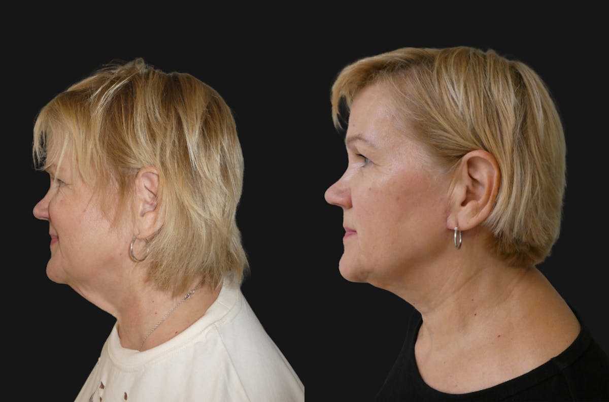 Neck Lift Before & After Gallery - Patient 389525 - Image 1