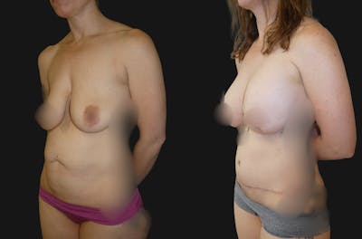 Mommy Makeover Before & After Gallery - Patient 420190 - Image 1