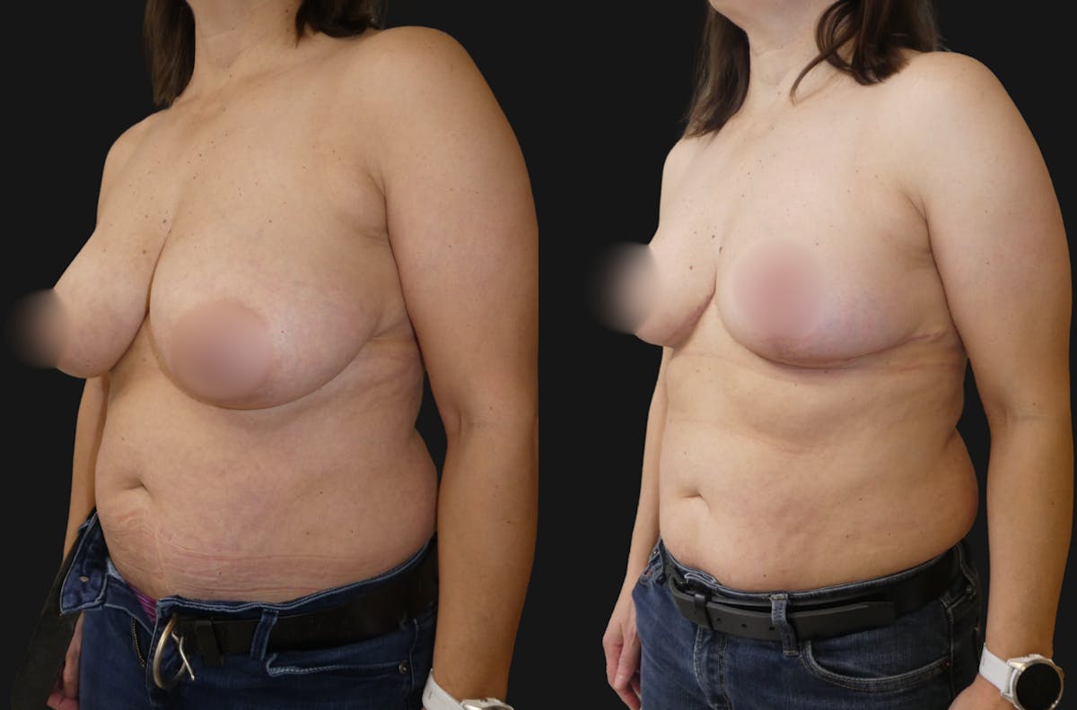 Mommy Makeover Before & After Gallery - Patient 249917 - Image 1