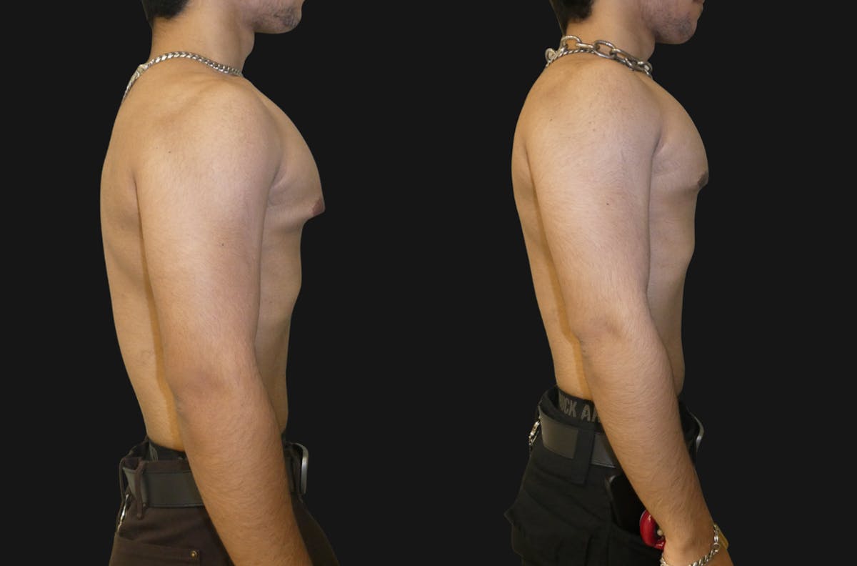 Gynecomastia Before & After Gallery - Patient 188093 - Image 1