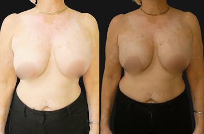 Breast Augmentation Before & After Gallery - Patient 303232 - Image 1