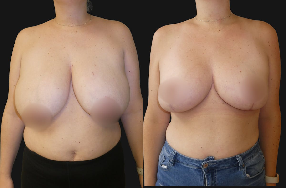 Breast Reduction Before & After Gallery - Patient 394851 - Image 1