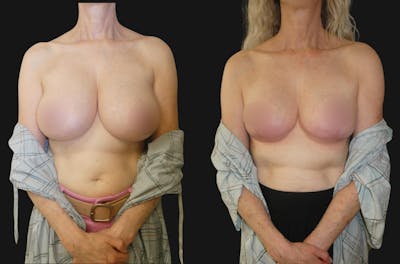 Breast Reduction Before & After Gallery - Patient 136497 - Image 1