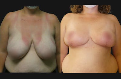 Breast Reduction Before & After Gallery - Patient 313942 - Image 1