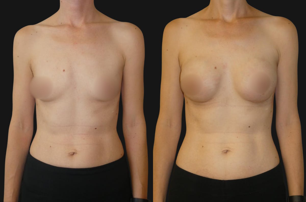 Breast Augmentation Before & After Gallery - Patient 427437 - Image 1