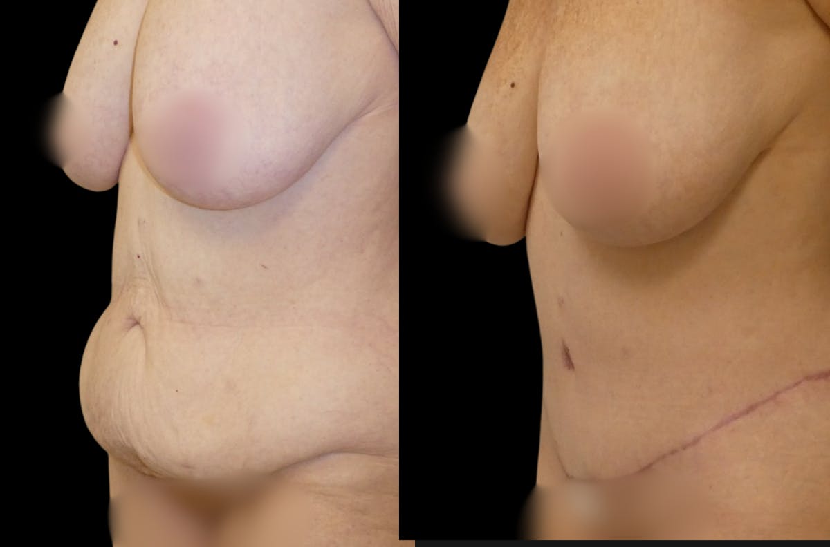 Tummy Tuck / Abdominoplasty Before & After Gallery - Patient 200559 - Image 1
