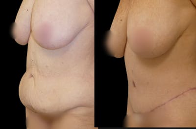 Tummy Tuck / Abdominoplasty Before & After Gallery - Patient 200559 - Image 1