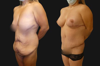 Body Lift Before & After Gallery - Patient 731851 - Image 1