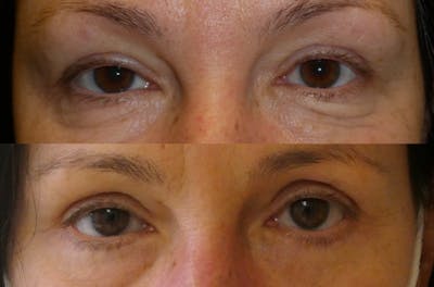 Blepharoplasty Before & After Gallery - Patient 286125 - Image 1