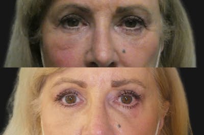 Blepharoplasty Before & After Gallery - Patient 237607 - Image 1