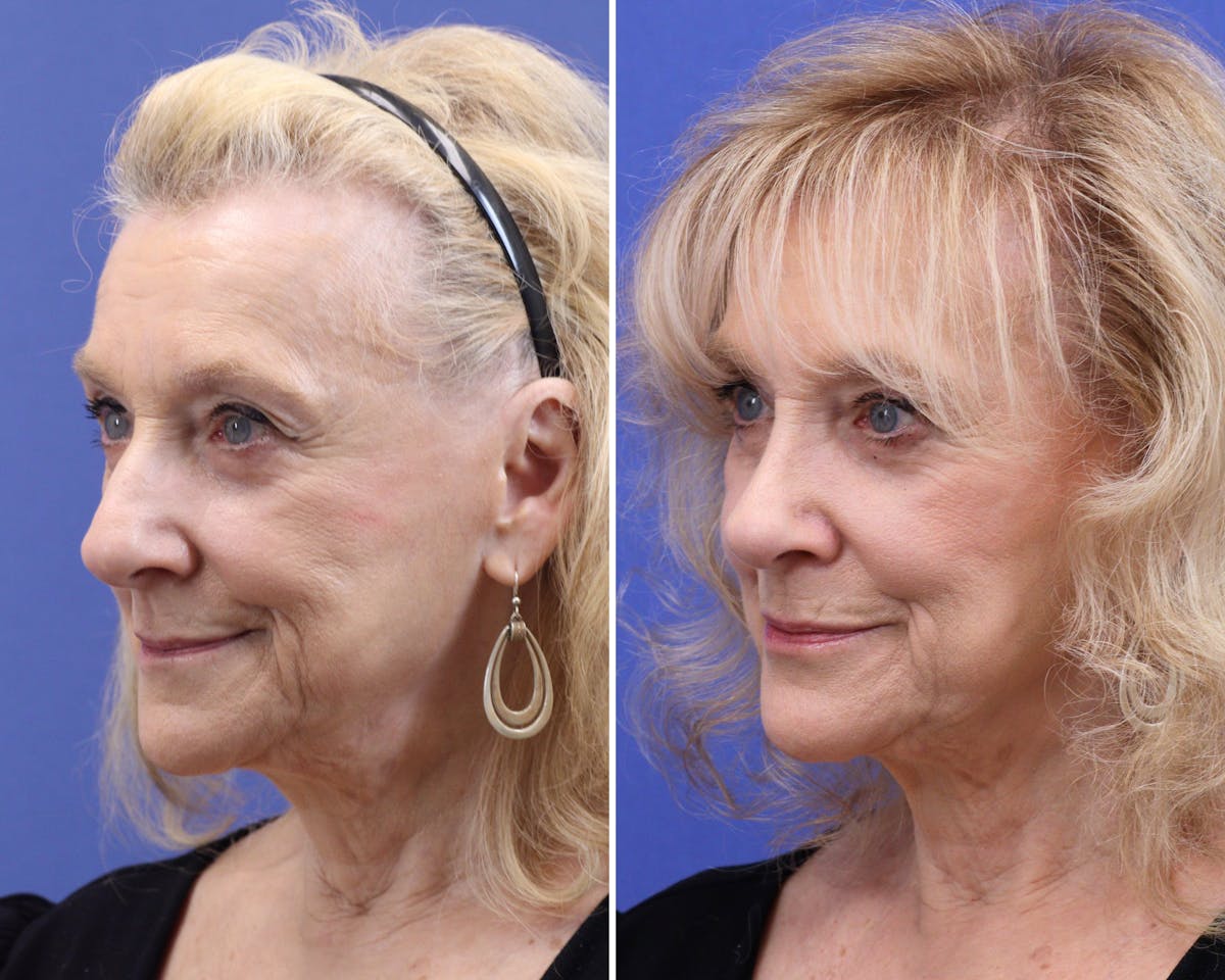 Rhinoplasty Before & After Gallery - Patient 324505 - Image 2