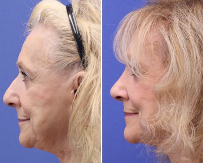 Rhinoplasty Before & After Gallery - Patient 324505 - Image 1