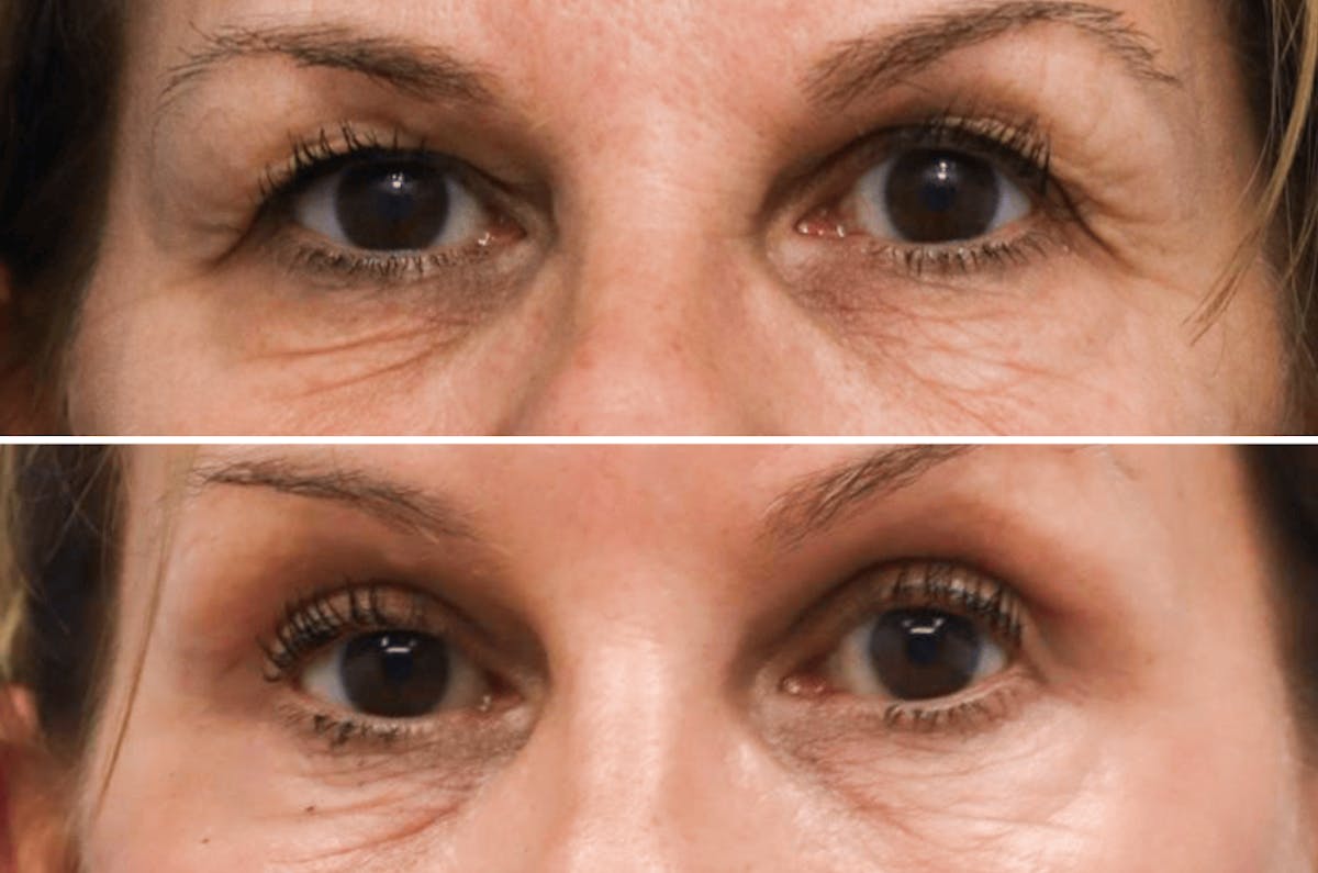 Blepharoplasty Before & After Gallery - Patient 129201 - Image 1