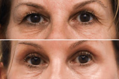 Blepharoplasty Before & After Gallery - Patient 129201 - Image 1