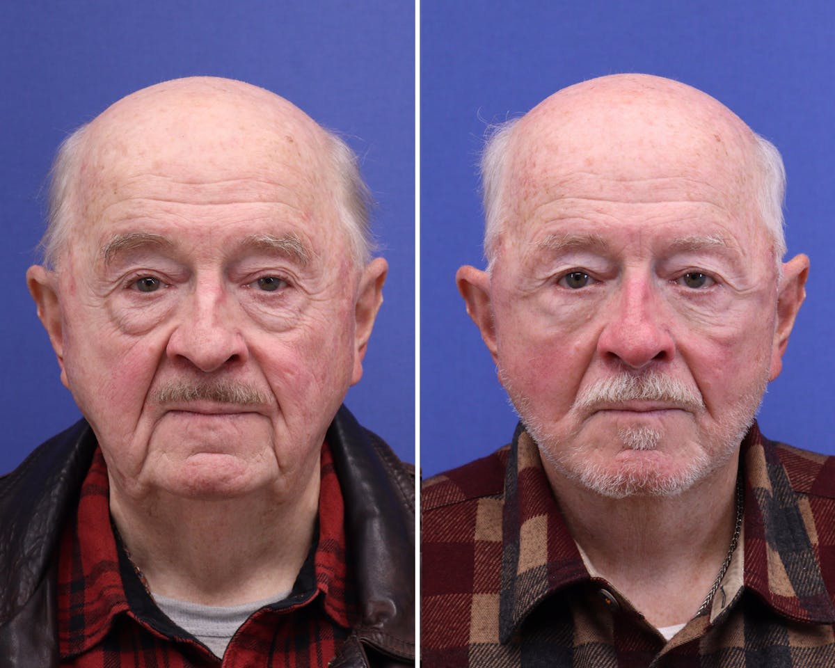 Face Before & After Gallery - Patient 378470 - Image 1