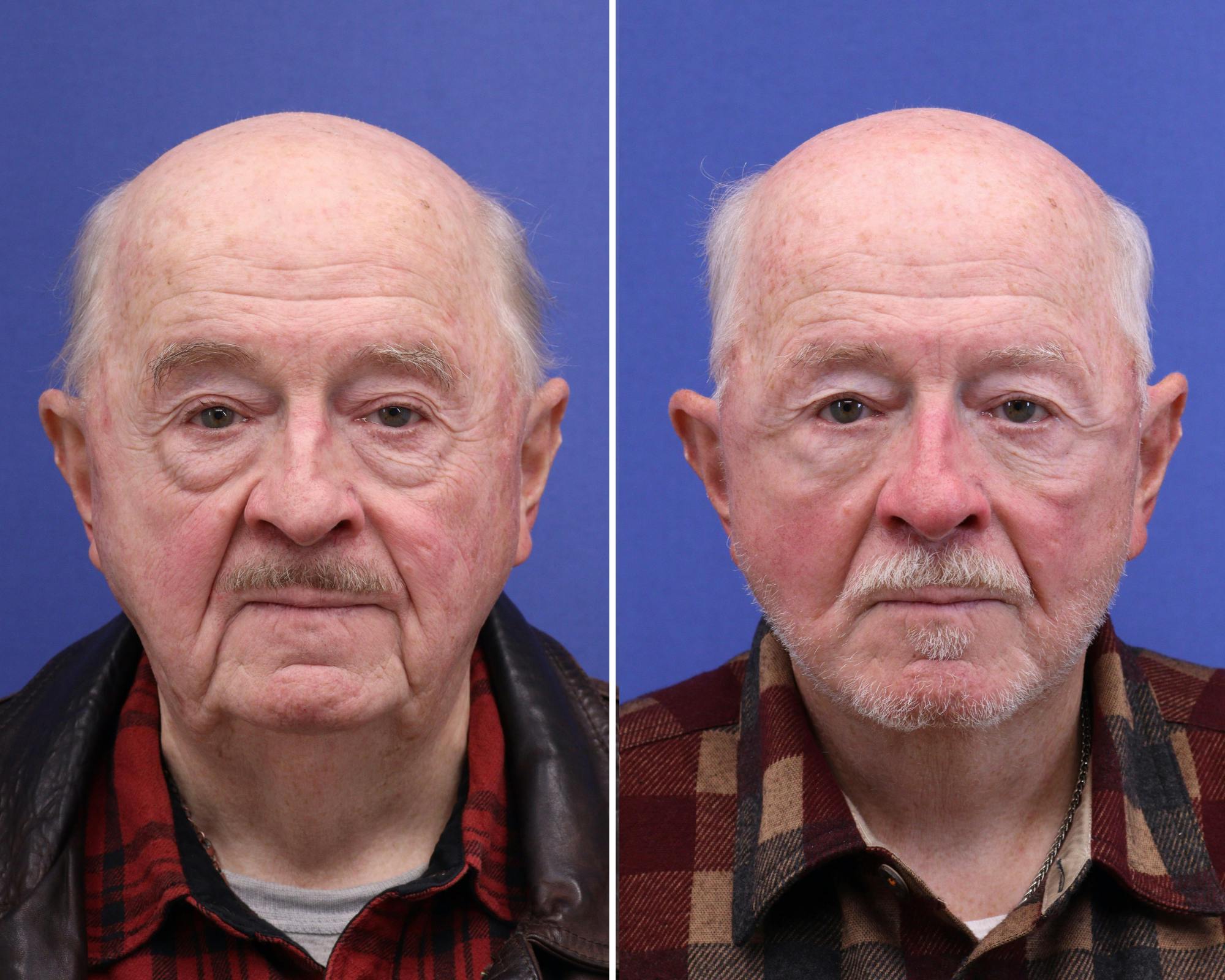 Face Before & After Gallery - Patient 378470 - Image 1