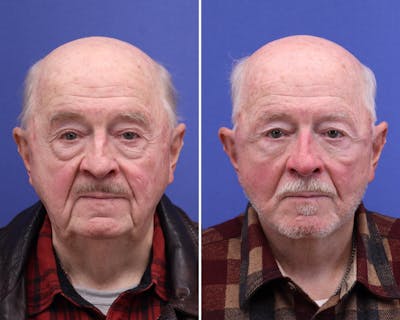 Face Before & After Gallery - Patient 378470 - Image 1