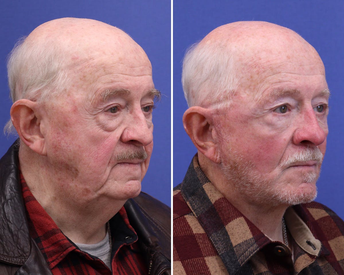 Face Before & After Gallery - Patient 378470 - Image 2