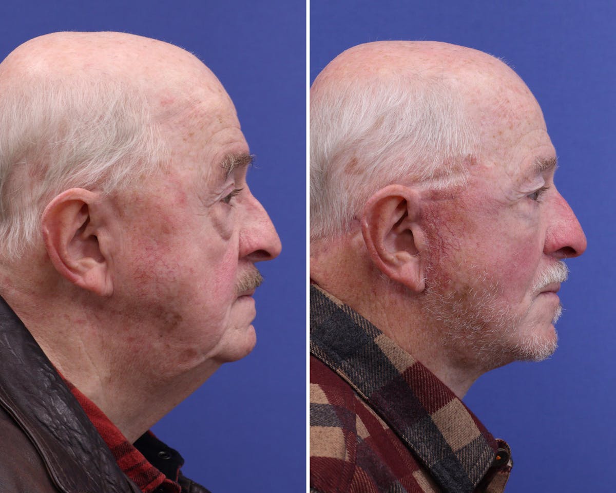 Face Before & After Gallery - Patient 378470 - Image 3