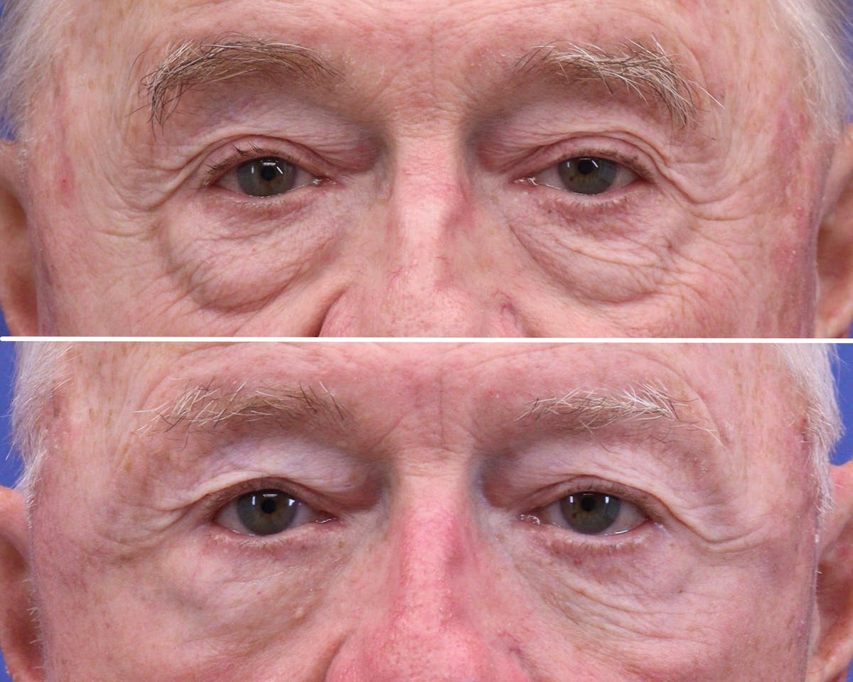 Eyelids Before & After Gallery - Patient 169766 - Image 1