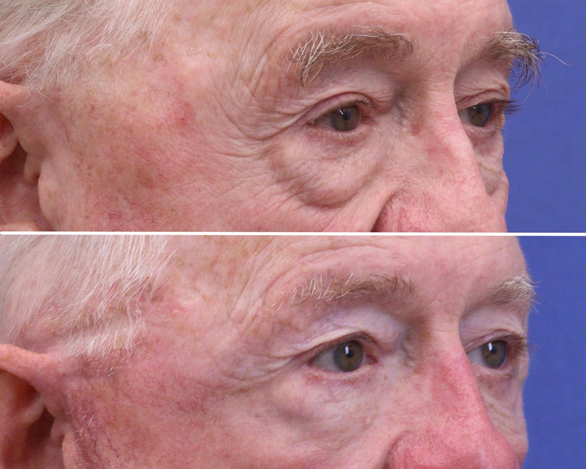 Eyelids Before & After Gallery - Patient 169766 - Image 2