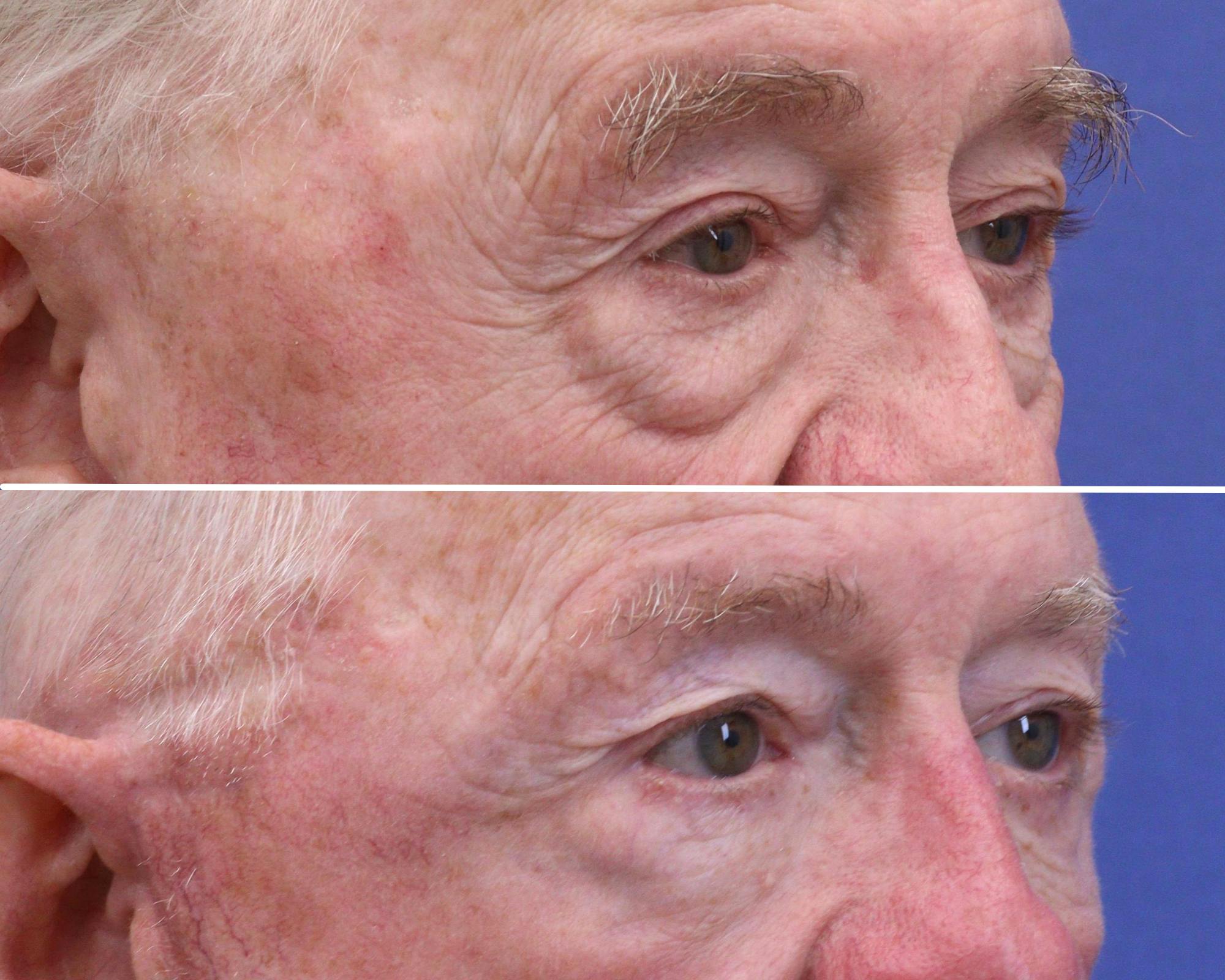 Eyelids Before & After Gallery - Patient 169766 - Image 2