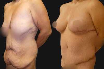 Weight Loss Body Contouring Before & After Gallery - Patient 731851 - Image 1
