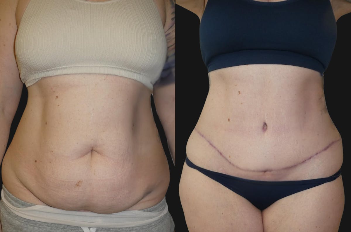 Tummy Tuck / Abdominoplasty Before & After Gallery - Patient 563352 - Image 1