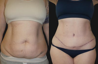 Tummy Tuck / Abdominoplasty Before & After Gallery - Patient 563352 - Image 1