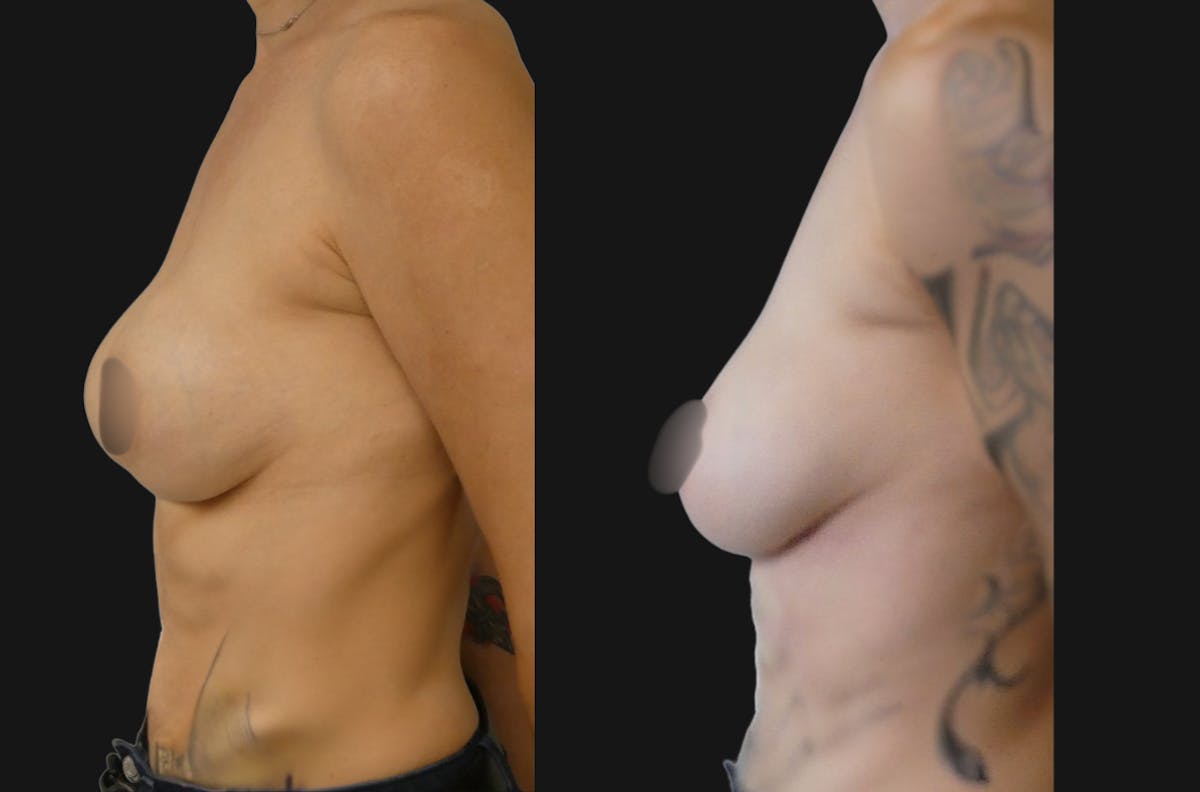 Breast Revision Before & After Gallery - Patient 372396 - Image 5