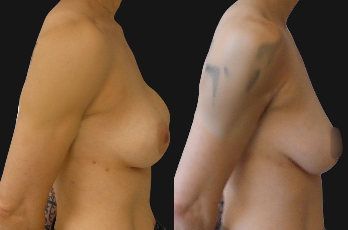 Breast Revision Before & After Gallery - Patient 372396 - Image 3