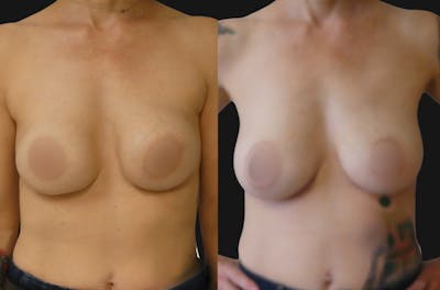 Breast Revision Before & After Gallery - Patient 372396 - Image 1