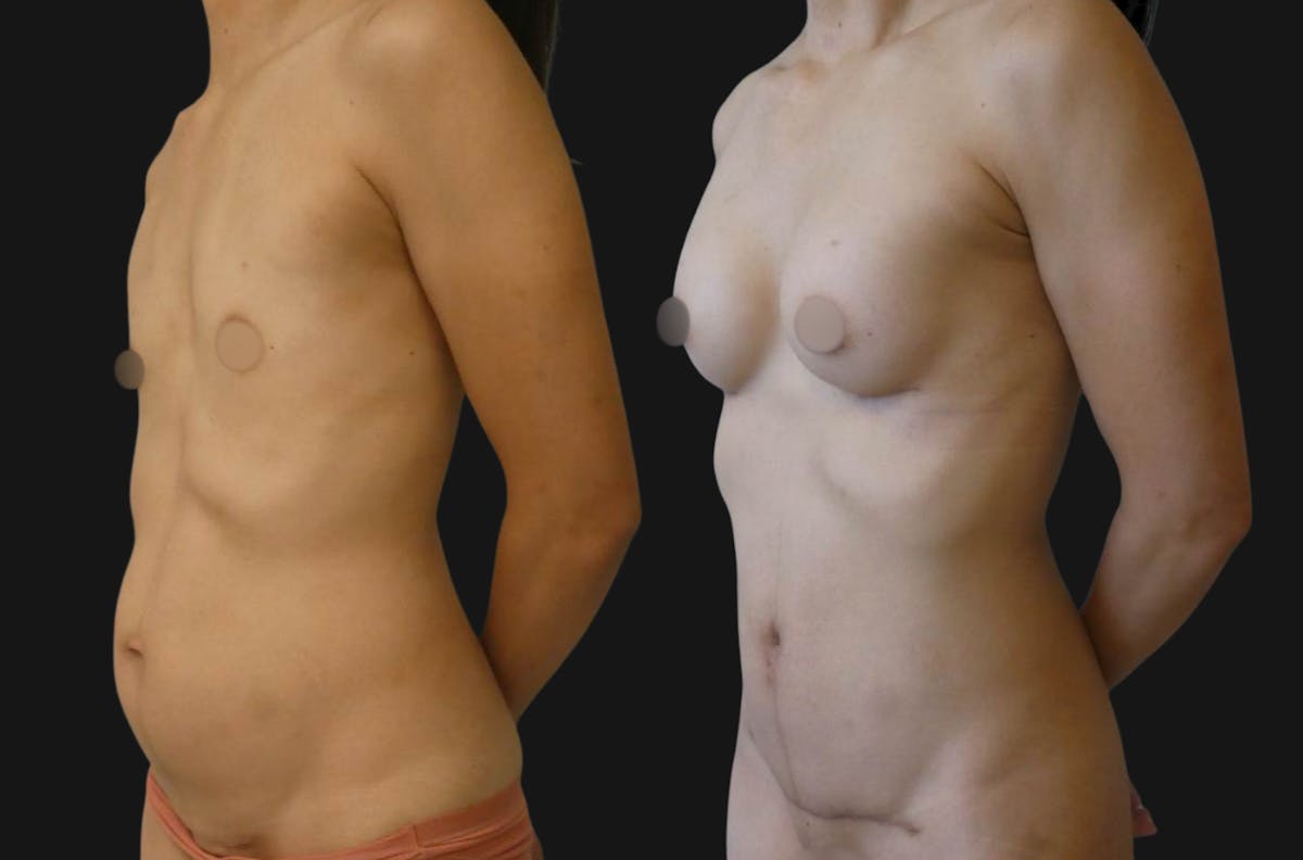 Mommy Makeover Before & After Gallery - Patient 965025 - Image 2