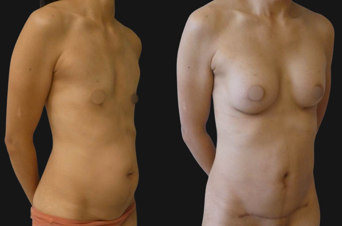 Mommy Makeover Before & After Gallery - Patient 965025 - Image 3