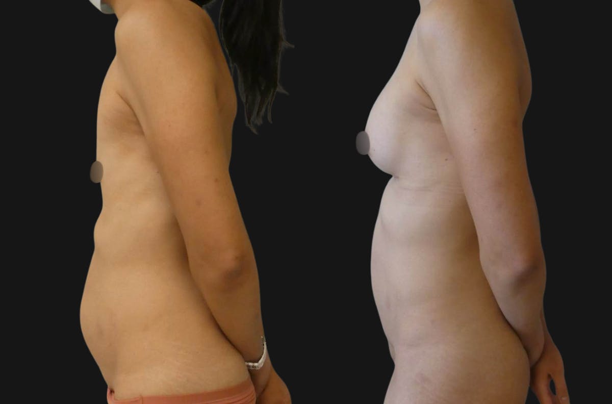 Mommy Makeover Before & After Gallery - Patient 965025 - Image 4